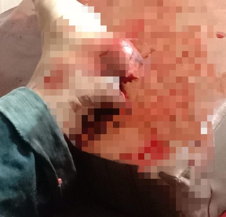 Pengendara Vario Terjungkal, Kaki Fauzi Terbelah Usai Tabrak Becak Tak Miliki Lampu di Tanjung Tiram