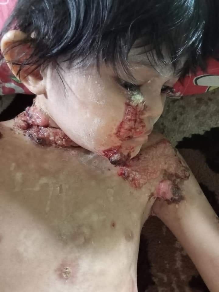 Nadia Amira Bocah 8 Tahun, Warga Desa Aras, Terkena Penyakit Aneh, Butuh Uluran Tangan Para Dermawan