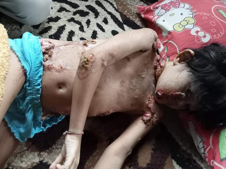 Nadia Amira Bocah 8 Tahun, Warga Desa Aras, Terkena Penyakit Aneh, Butuh Uluran Tangan Para Dermawan