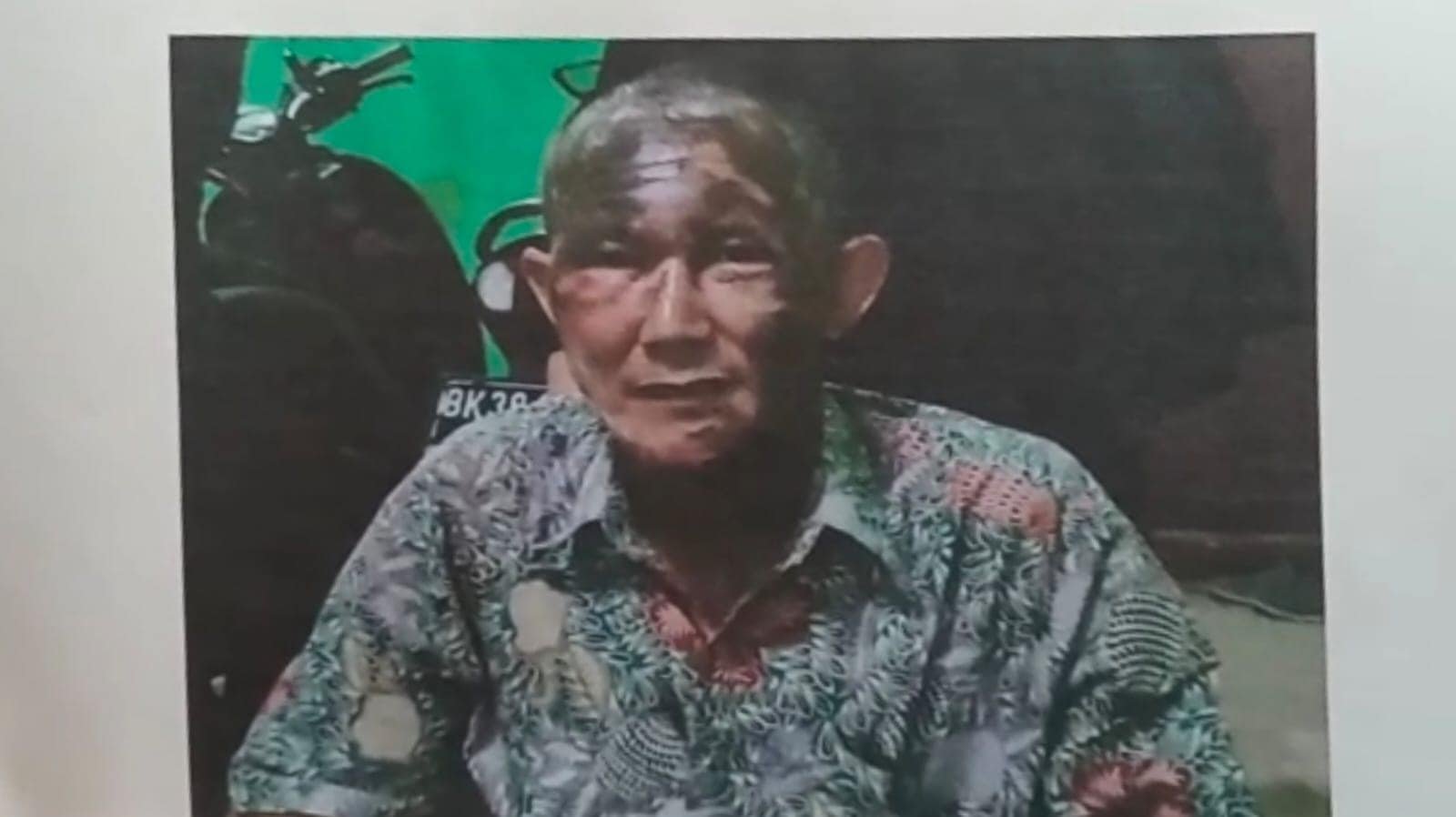 Korban Irsyad mukanya melepuh usai disiram air keras, Asahan (4/1/2022). (Dok/Humas).